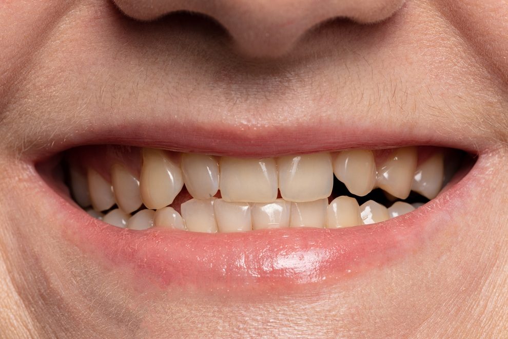 teeth whitening before and after close-up