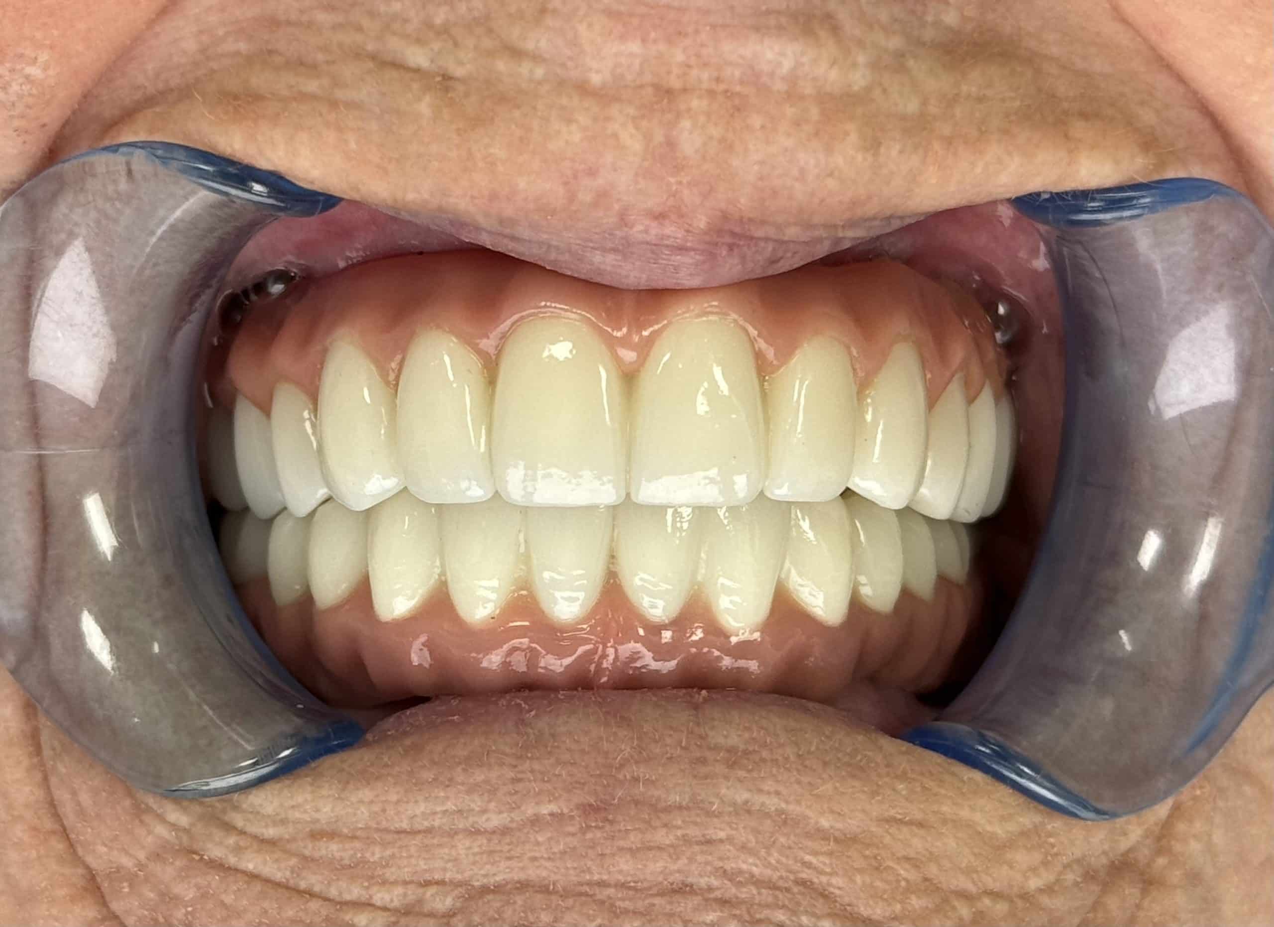 All on Four Implant Case 1 After