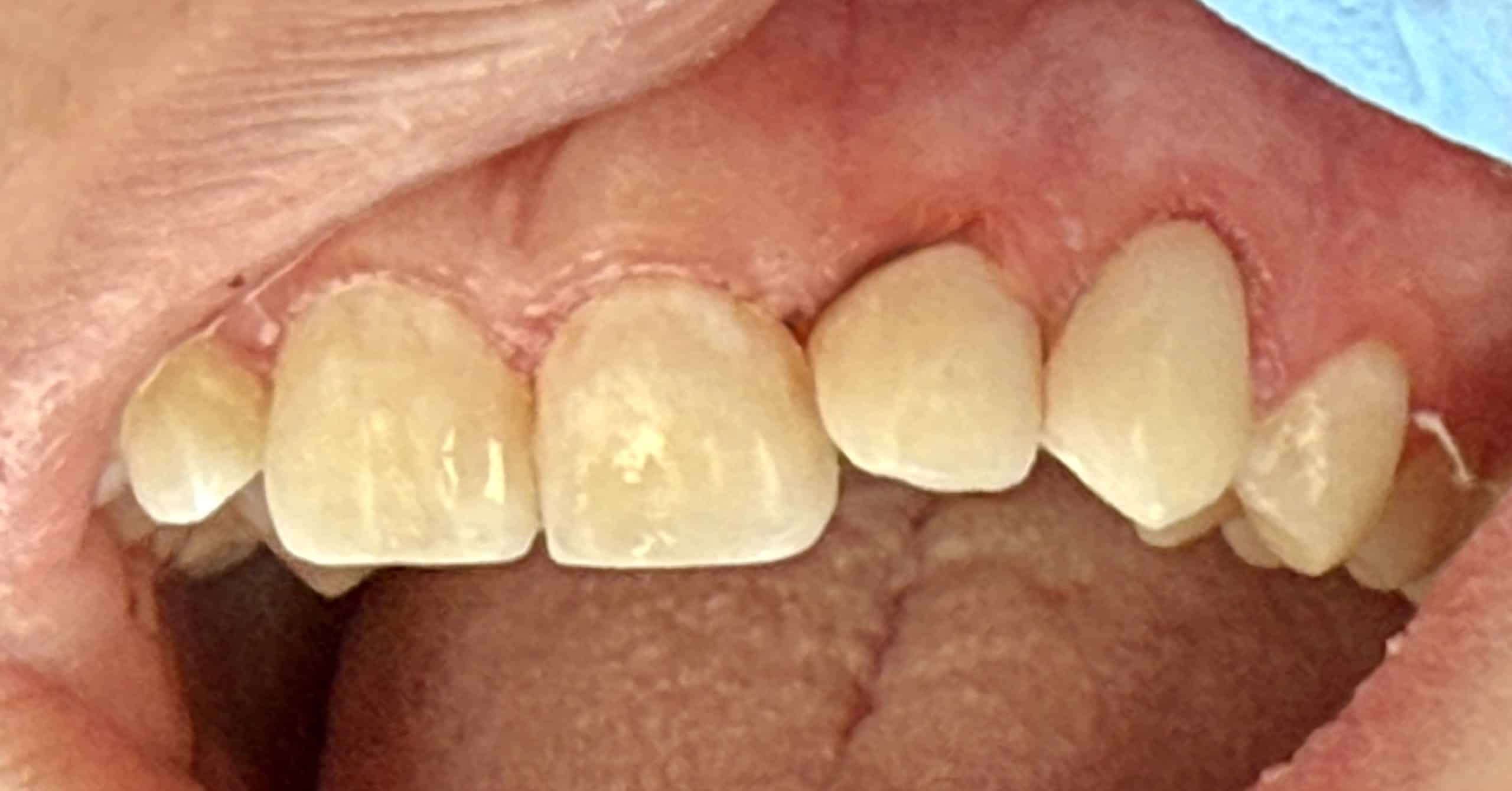 Composite Filling Case #1 After