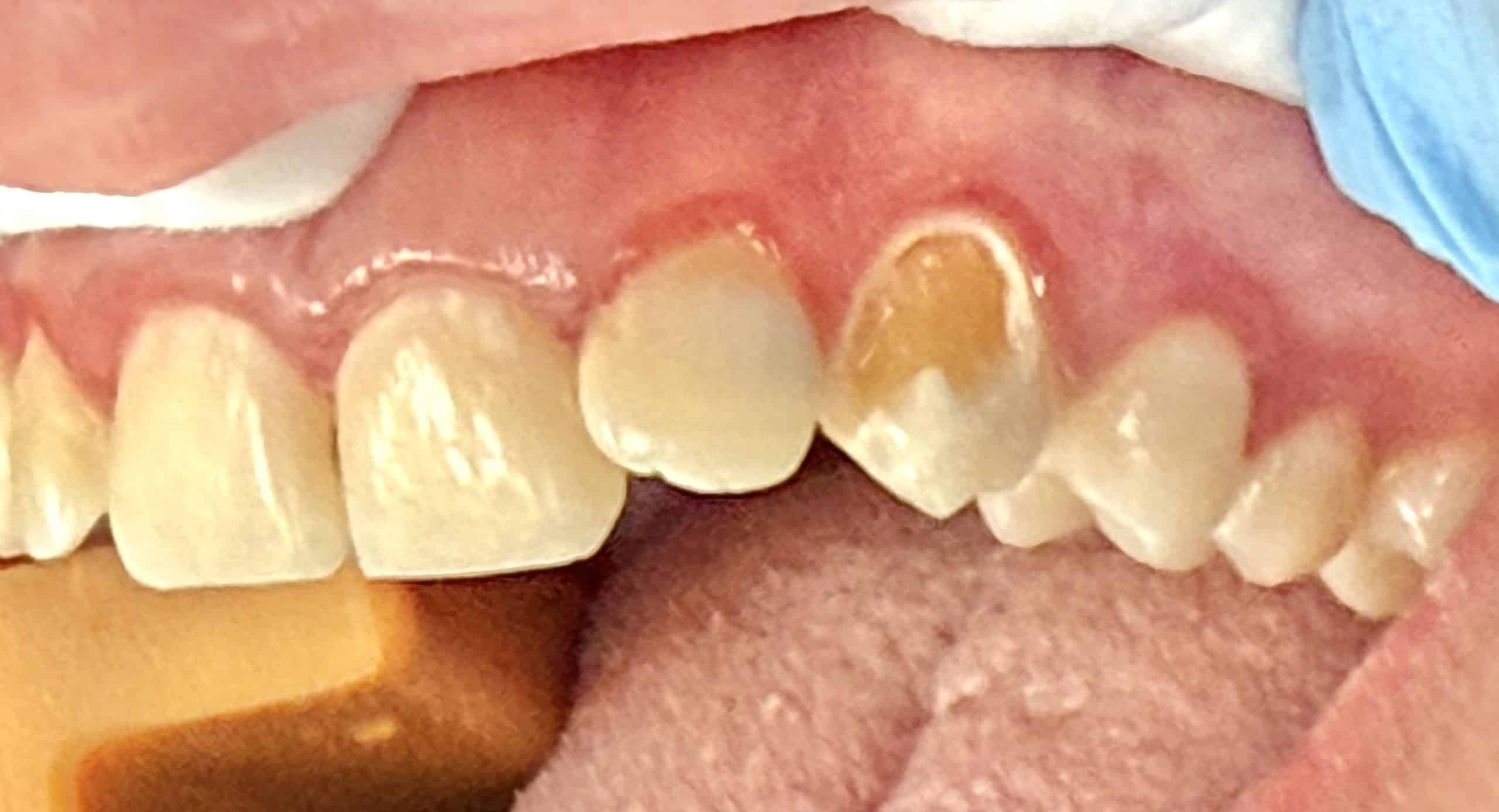 Composite Filling Case #1 Before