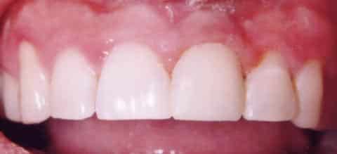 Composite Filling Case #2 After