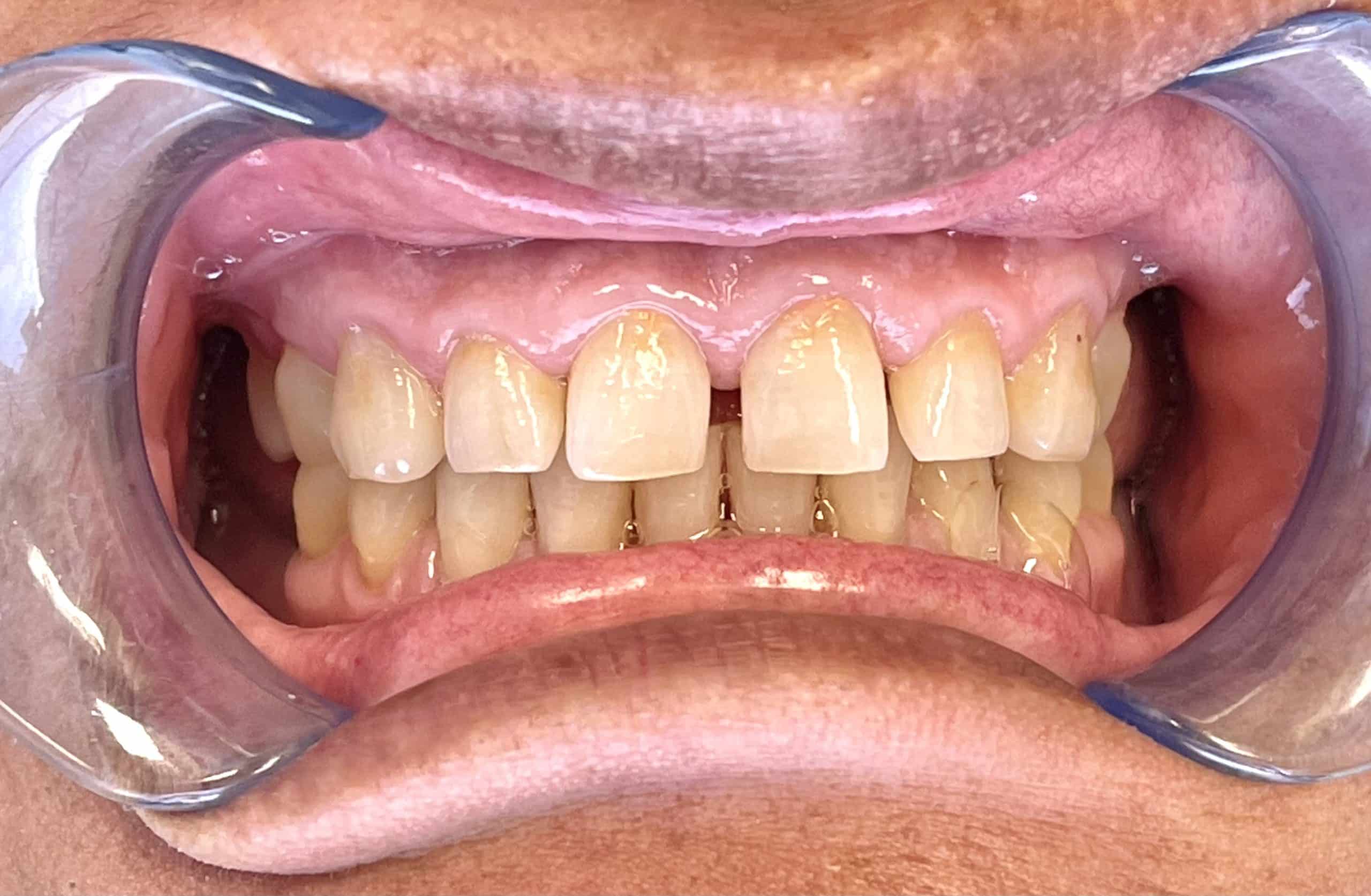 Crowns Case #1 Before