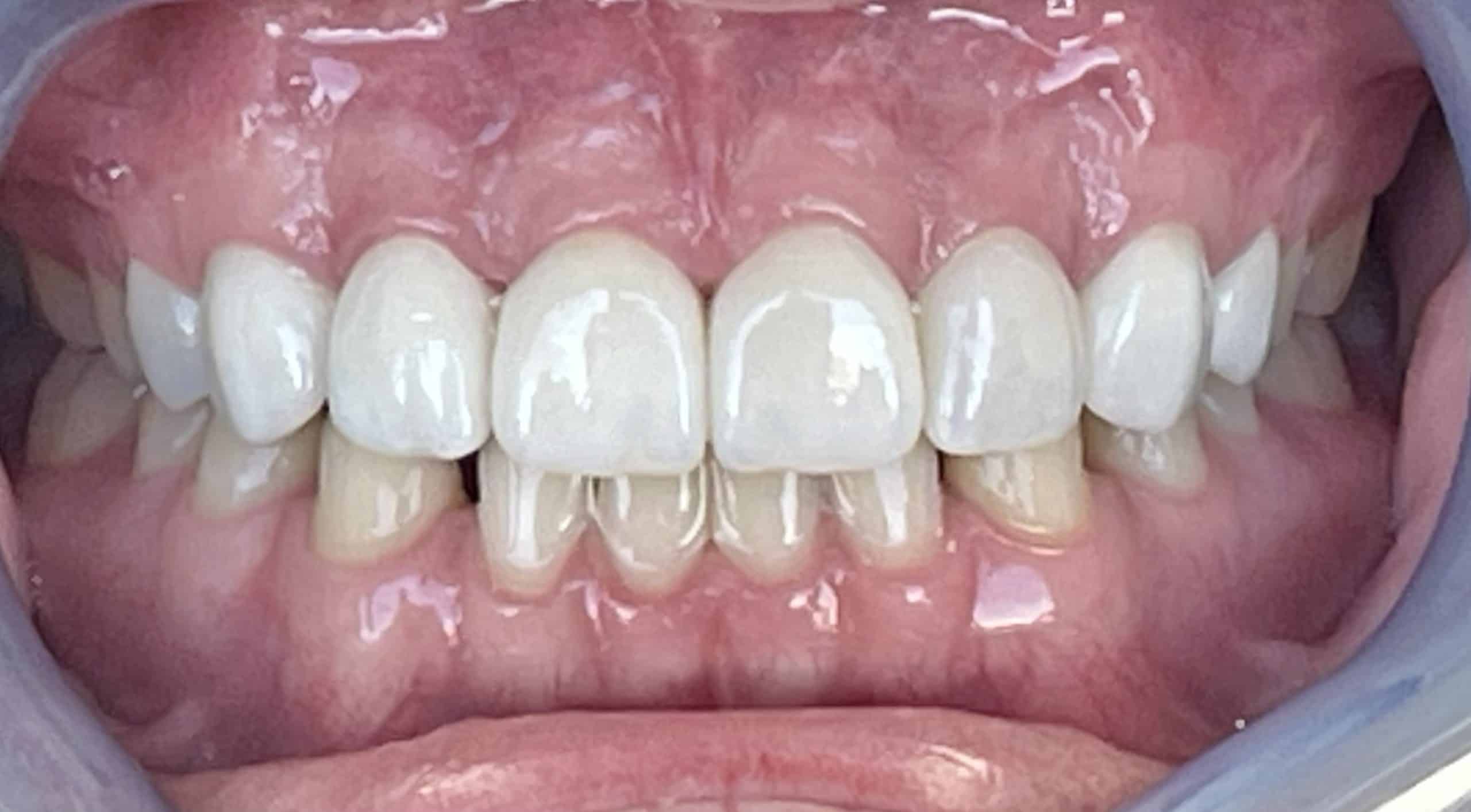 Crowns Case 5 After