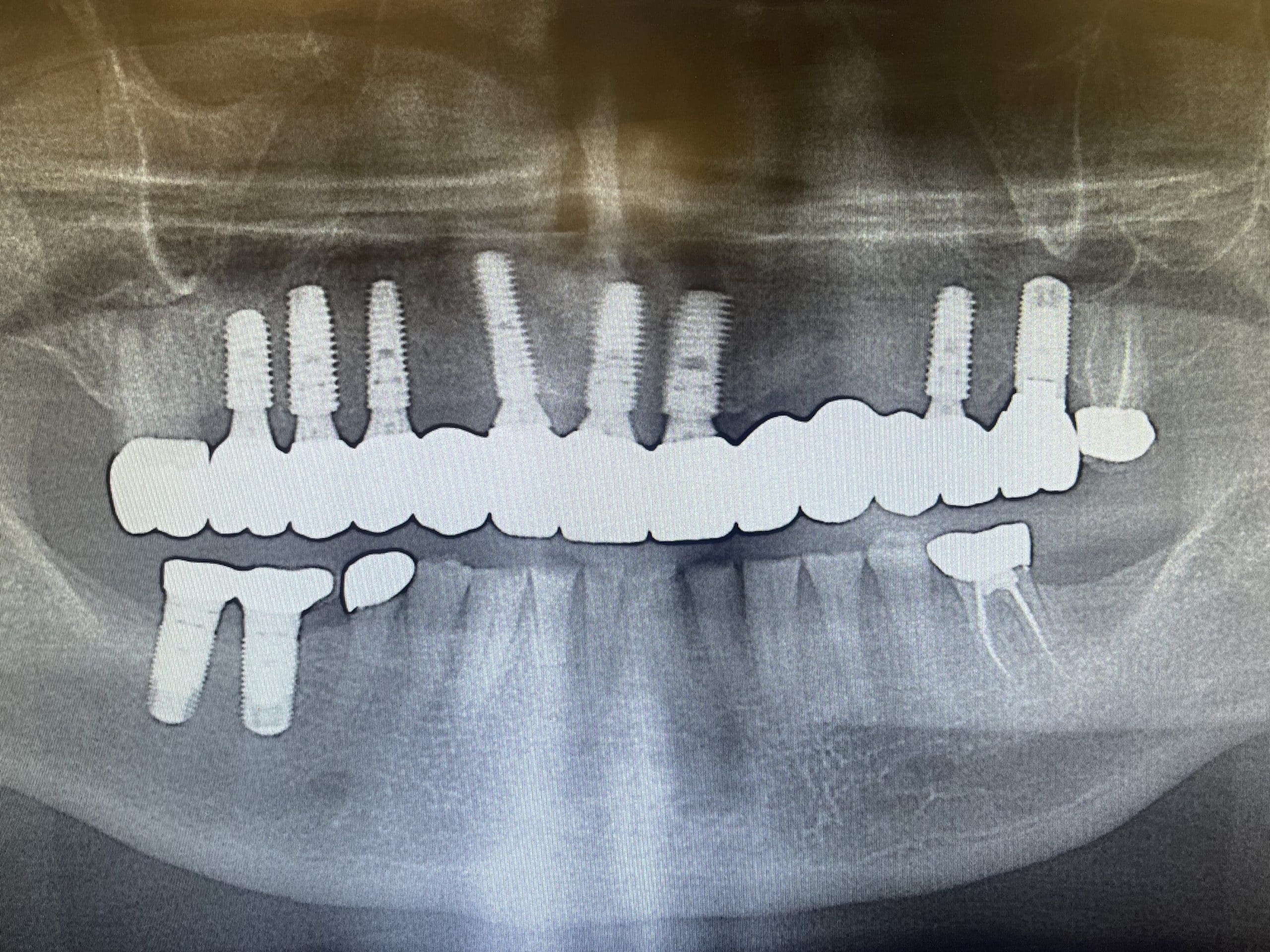 Implant Supported Bridge