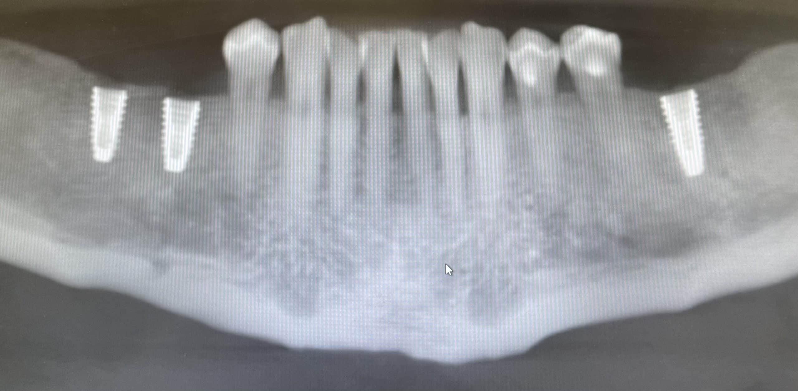 Surgical Guide Implant Placement 1