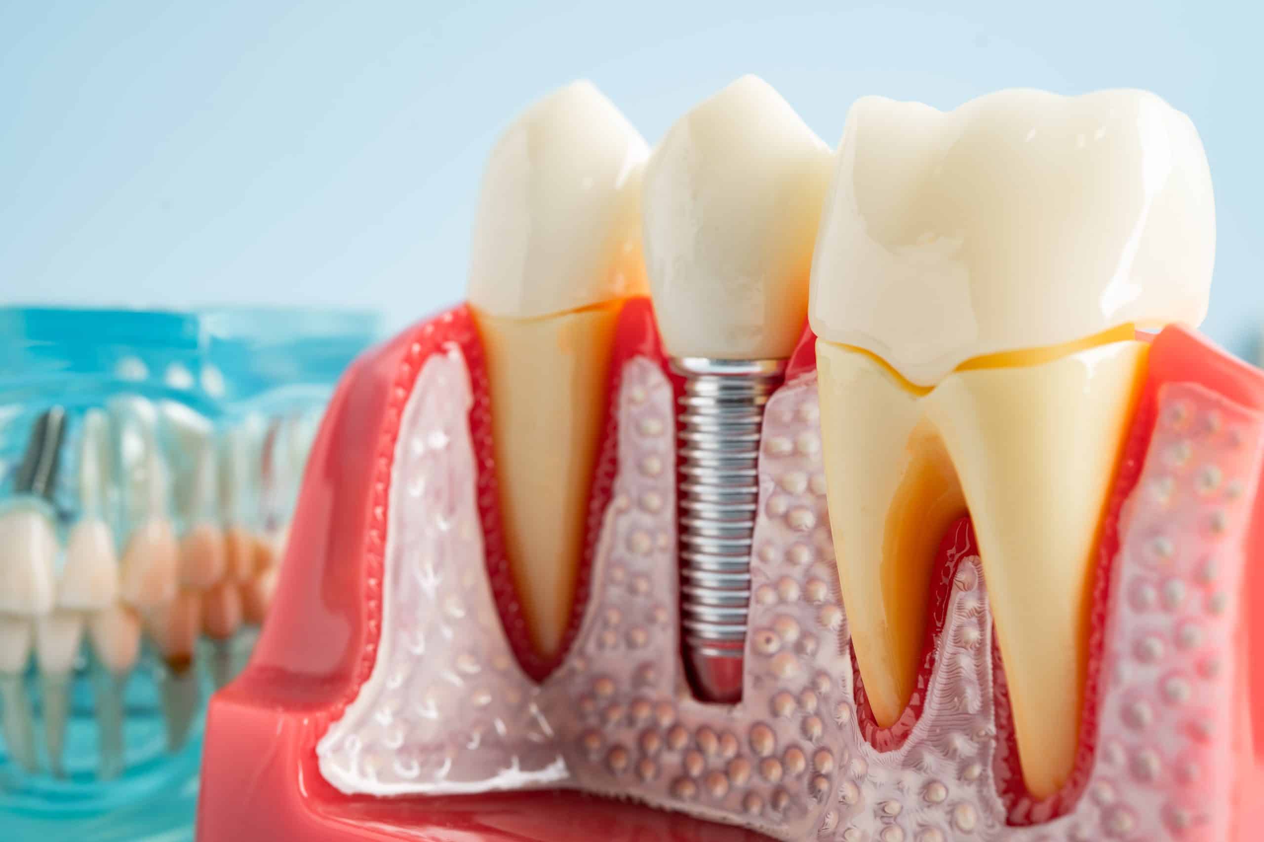 bone graft for dental implants in West Valley City, UT